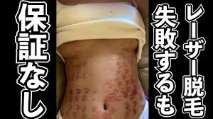 閲覧注意】AV女優・宝生リリー、アマソラクリニックのドラゴン細井にハメられ脱毛部位にやけどを負う (2ページ目) - Togetter
