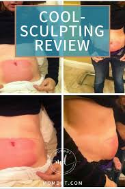 Coolsculpting Does It Work Cost Before And After Cool Sculpting Diy Coolsculpting Liposuction
