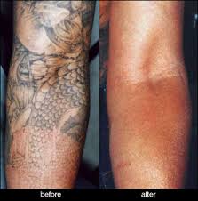 The laser tattoo removal price increases by appx. Laser Tattoo Removal Toronto Downtown Baywood Laser Clinic
