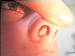 Small nasal polyps may not cause symptoms. Polyps In The Nose Treatment With Ayurveda Ayurveda Bansko