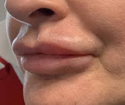 Sally Sherrard, San Francisco Aesthetic Pa-C | When It'S Time To Dissolve  Migrated Lip Filler And Start Over… Why Does Lip Filler Migration Happen?  There Isn'T An Exact Answer But… | Instagram