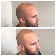 Tattoo under hairline comes to the rescue! Hair Tattoos Before After Baltimore Scalp Pigmentation Shows By Bill Martin Baltimore Scalp Micropigmentation Medium