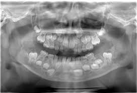 Panoramic radiograph xray training for dentist and dental staff. Identification Of A Point Mutation In The Sh3bp2 Gene In Cherubism Sciencedirect