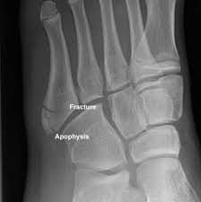 Metatarsal fracture avulsion fracture fracture healing stress fracture jones fracture types of fractures ankle ligaments broken foot physical therapy. Base Of 5th Metatarsal Fracture And Apophysis This Case Illustrates The Difference In The Appearance Of An Avu Jones Fracture Radiology Ultrasound Technician