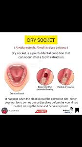 Image result for Alveolitis sicca)
