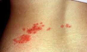 Afectiunea are trei etape de dezvoltare, fiecare dintre ele caracterizata de anumite. Cum Recunoastem Zona Zoster 24 Ore