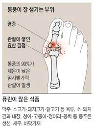 남기세병원 조훈식 말말] 통풍, 임산부의 고통!!… 요산 관리 평생 해야 : 네이버 블로그