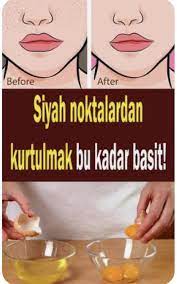 Siyah Noktalar Icin Maske Tarifleri Ve Dogal Oneriler Siyah Noktalar Siyah Lekeler Dogal