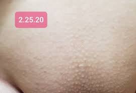 Brazilian laser hair removal at home: Brazilian Laser Hair Removal Ideal Image Columbus Columbus