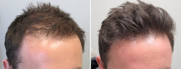 Another report on women using minoxidil also resulted in subjects experiencing severe hypertrichosis (excessive hair growth) on the face and limbs after using 5. How Effective Is Minoxidil For Hair Growth Quora