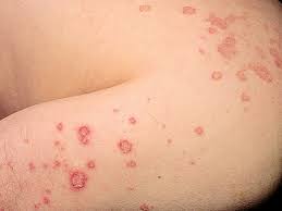 Image result for Atopic eczema atopic dermatitis