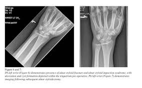 Pdf] Imaging Findings In Ulnar-Sided Wrist Impaction Syndromes. | Semantic  Scholar