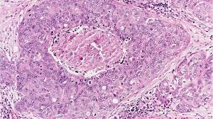Types Of Breast Cancer Breast Pathology Johns Hopkins Pathology