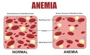 Image result for Anemia