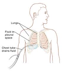 The risk factor for collapsed lung or pneumothorax increases if cigarette smoking is increased even there is no emphysema. Chest Tubes Saint Luke S Health System