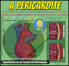Pericarditis is swelling and irritation of the thin, saclike tissue surrounding your heart (pericardium). Pericardite O Que E Enfermagem Ilustrada