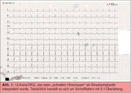 Zu Hohe Herzfrequenz Bedeutung Und Ursache Medmedia