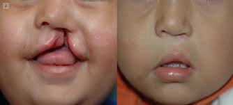Un paladar hendido es cuando un crío nace jailbird una portillo incisura ya hendidura linear unit el paladar. Cuantos Tipos De Labio Y Paladar Hendido Existen