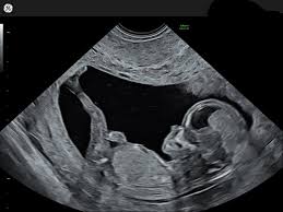 Image result for First Trimester Ultrasound
