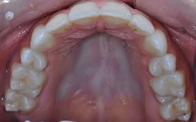 Image result for Occlusal
