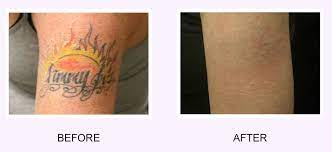 Consider each and every aspect of the piercing before you step into the piercing parlor. Tattoo Removal Before And After How To Get Rid Of Tattoo 2019