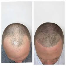 See photos, profile pictures and albums from scalp aesthetics. Maintaining Your Scalp Micropigmentation Untitled