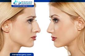You can eat up until 12 hours before being given general anesthesia. What To Eat Before Rhinoplasty Foods To Avoid Before Rhinoplasty