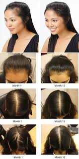 Hair Loss In Women Causes And Symptoms Hair Loss Women Hair Loss Treatment Hair Loss Women Treatment