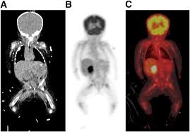 Prepare to spend 2 hours with us. Weight Based Low Dose Pediatric Whole Body Pet Ct Protocols Journal Of Nuclear Medicine