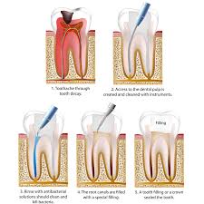 Image result for Tooth Extraction