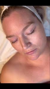 At All Things Skin Bar, We Don’t Play About Your Glow ✨. ✨Before & After  ✨hydrodermabrasion 🌟. 👋Say goodbye to dull, tired skin and hello to a  radiant, refreshed complexion! 💦This powerful treatment ...