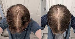 Microneedling offers fairly immediate results. Finasteride And Microneedling 11 Month Results Hairlosstalk Forums