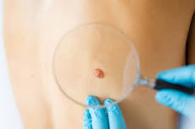 Here's how to watch out for your own skin. 3 Signs Your Mole Might Be More Hollywood Dermatology