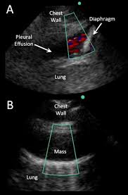 Introduction pleural effusion is an excessive accumulation of fluid in the pleural space resulting from excess fluid the exclusion criteria were loculated/encysted effusions, sometimes, the actual. Ultrasound And Pleural Effusions Journal Of Hospital Medicine