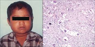 Cherubism is a rare genetic condition that affects the bones of your lower jaw and sometimes upper jaw. Cherubism A Case Report With Long Term Follow Up Chavali Lv Rao Bhimalingam R M Sudhakar P V Indian J Pathol Microbiol