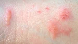 Image result for skin rash similar to scabies
