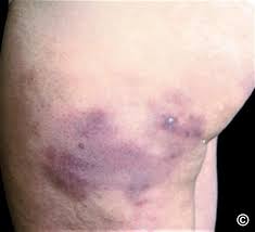 Image result for Panniculitis