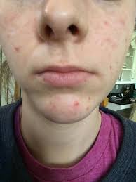 I was looking into solutions online for acne scars removal and found lots of talk about lasers and conflicting opinions of how possible the removal even is. Routine Help Fading Acne Scars On Differin Skincareaddiction