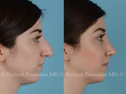 Nose job before and after female. Female Rhinoplasty Before And After Richard Zoumalan