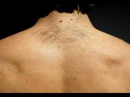 Generally, it's considered a grooming procedure. How To Quickly Remove Back Hair With Topical Cream Youtube