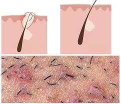 Ingrown Hairs Are A Small Balls Which Are Infected That Did Not Grow Or They Were Removed Incorrectl Treat Ingrown Hair Treating Ingrown Infected Ingrown Hair