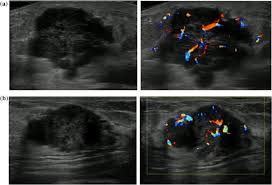 Sometimes the cancer cells can spread into the nearby lymph nodes. Machine Learning For Diagnostic Ultrasound Of Triple Negative Breast Cancer Springerlink
