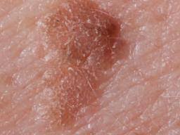 Check spelling or type a new query. Seborrheic Keratosis Symptoms Treatment And Causes