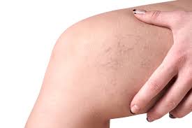 Are Varicose Veins Dangerous Venus Vein Clinic