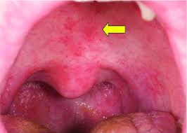 Residents and fellows contest rules | international ophthalmologists contest rules. Telangiectasia In The Oropharynx And High Arched Palate Download Scientific Diagram