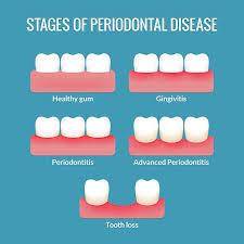 Image result for Periodontitis