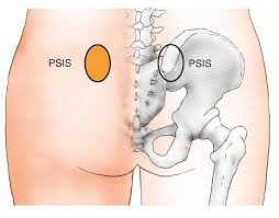Sacroiliitis or PSIS pain is a painful condition that affects one or both sacroiliac  joints. These joints sit where the lower spine and pelvis meet.  Sacroiliitis can cause pain and stiffness in