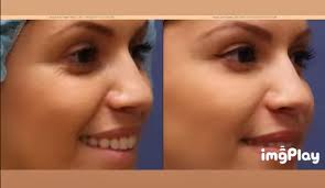 Botox Before and After