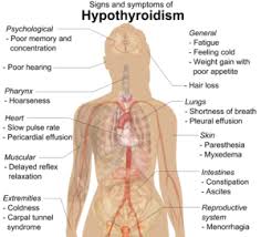 Hypothyroidism Wikipedia The Free Encyclopedia Hypothyroidism Symptoms Hypothyroidism Treatment Thyroid Treatment