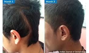 Whether or not the hair. Lupus Can Cause Rare Form Of Hair Loss Linear Non Scarring Alopecia